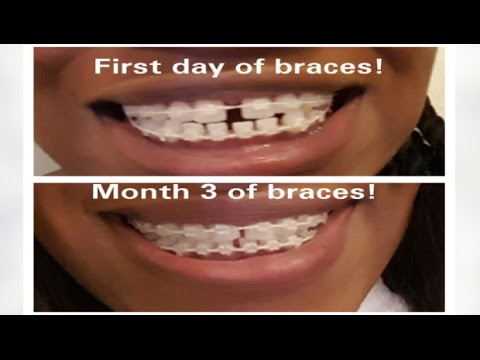 7 My Braces Journey  Mini Braces update  GAPS CLOSING  Vlogging my 