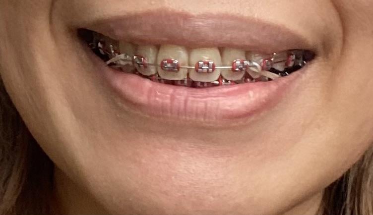 How Long Do Braces Take to Close Extraction Gaps in Urdu