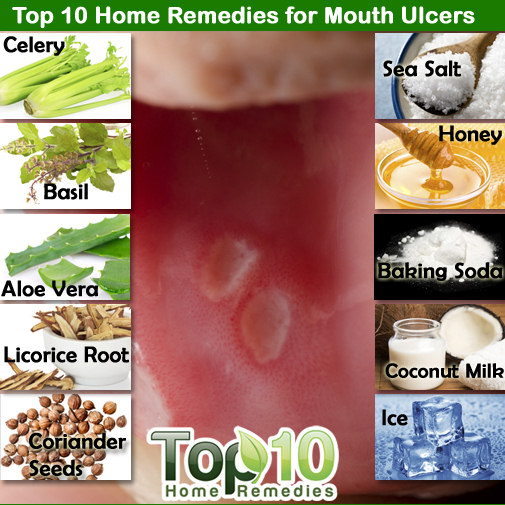 How to Treat Mouth Ulcers at Home in Urdu