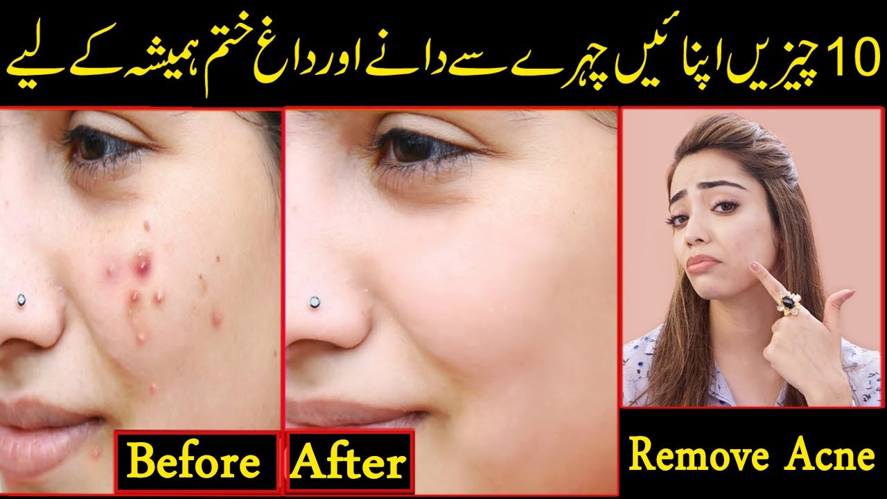 How To Remove Pimples And Dark Spot Skin Care Tips Acne Treatment