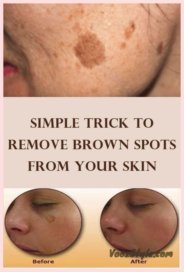 SIMPLE TRICK TO REMOVE BROWN SPOTS FROM YOUR SKIN Spots on face