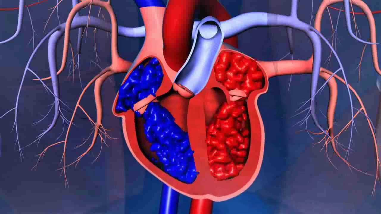 What are the different types of heart surgeries YouTube