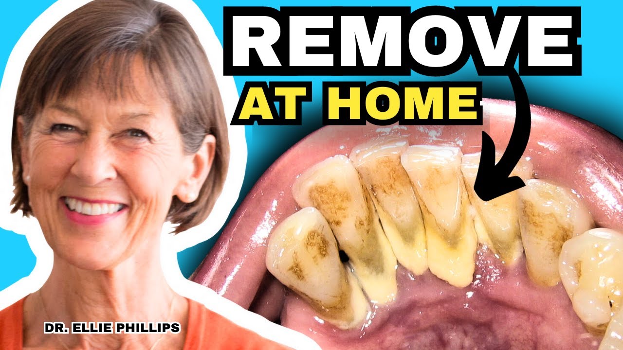 Tartar Removal At Home and How To Prevent Tartar YouTube