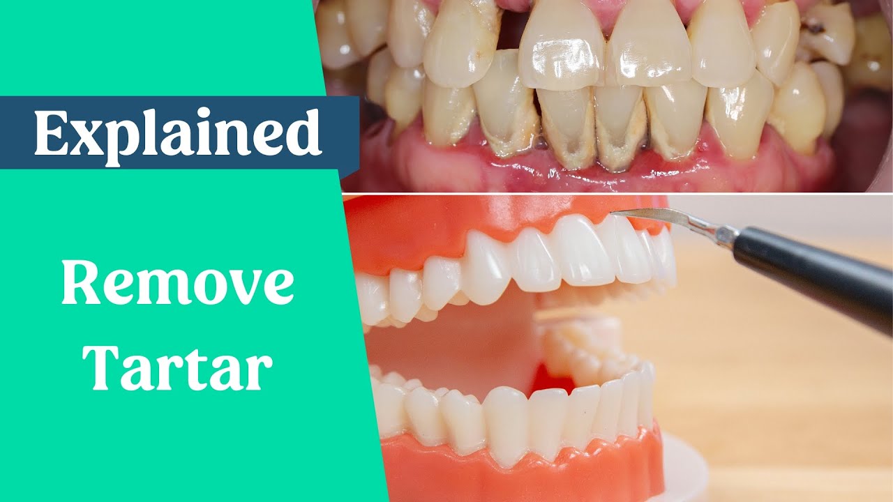 How to Remove Tartar from Teeth Without Dentist TheDentechcom