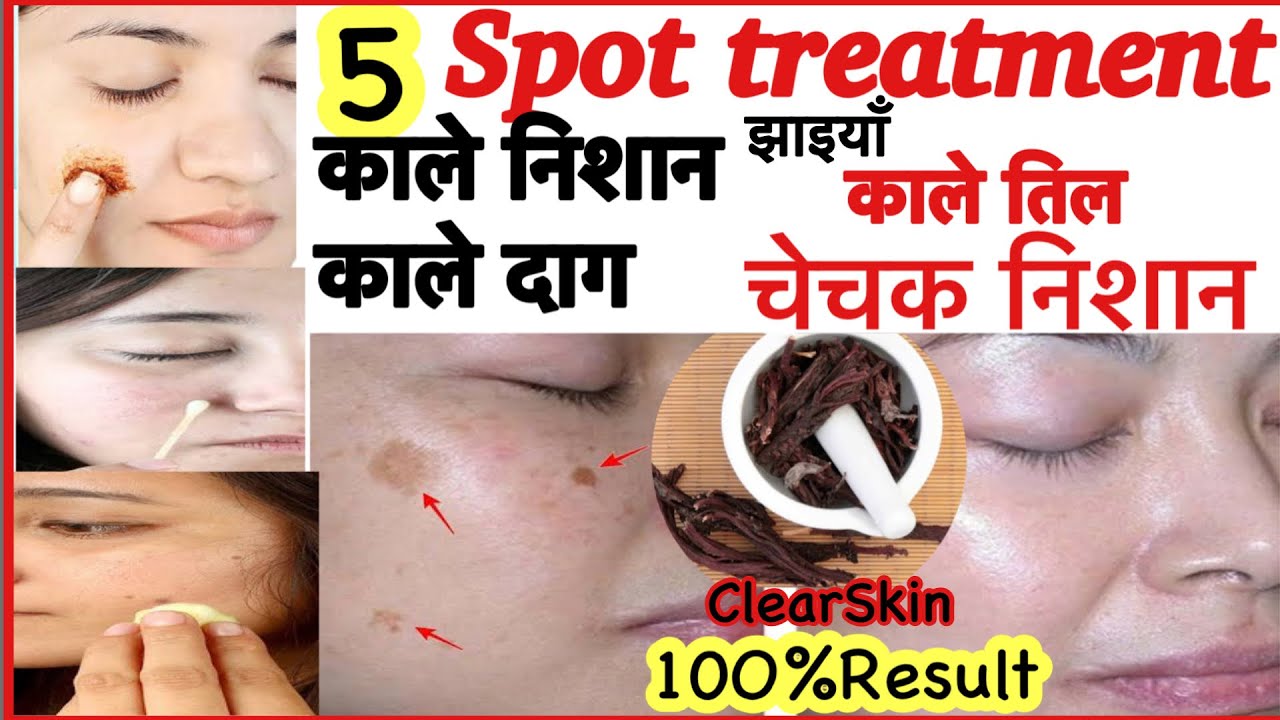 How to Get Rid of Dark Spots on Feet in Urdu