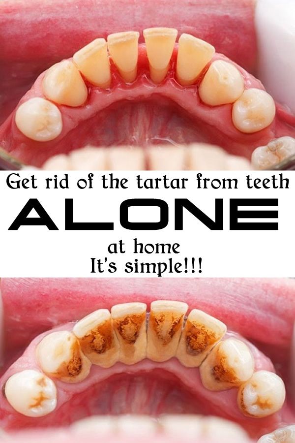 How to Clean Tartar from Teeth at Home in Urdu