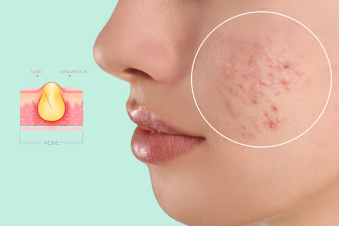 Quick Acne Treatment Mask  Nutripure