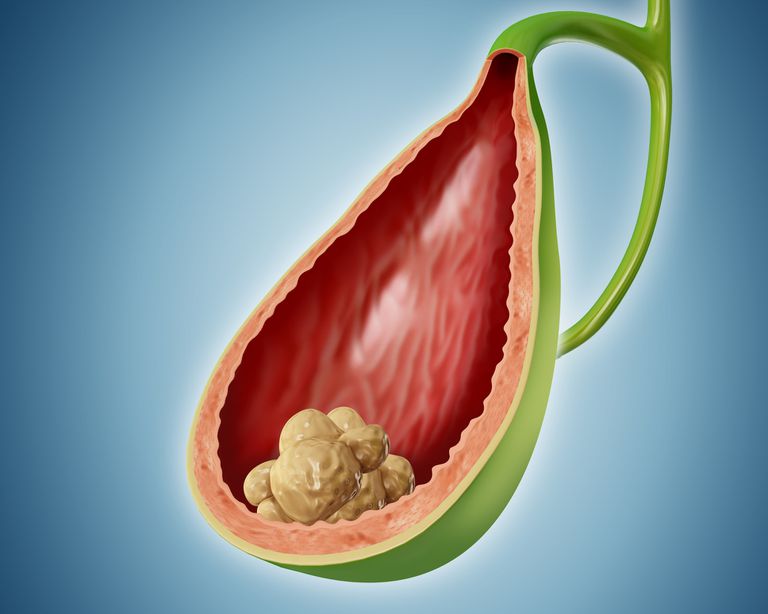 How to Stop a Gallbladder Attack While It Is Happening in Urdu
