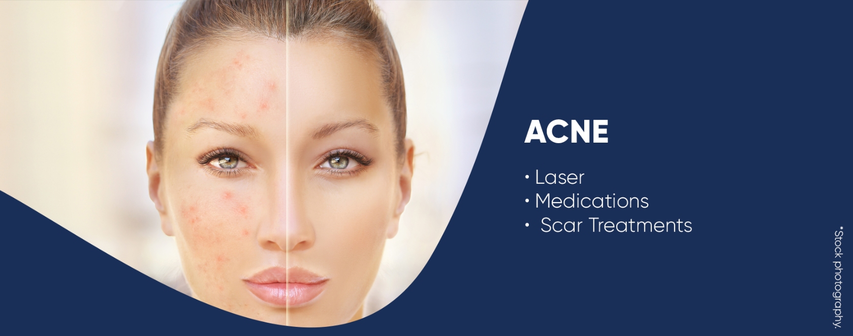 Acne Scar Laser Treatment  Aurora Dermatology