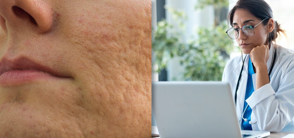 Acne Scars An Update on Management