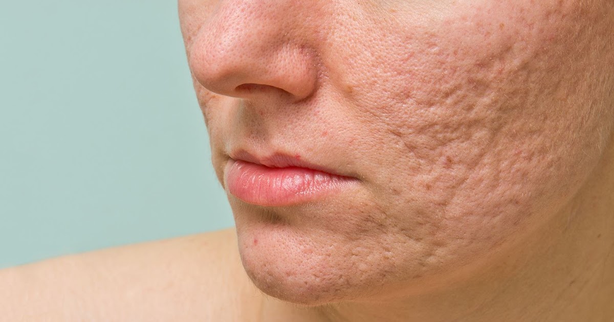 LATEST TREATMENT METHODS OF ACNE SCARS IN COSMETOLOGY