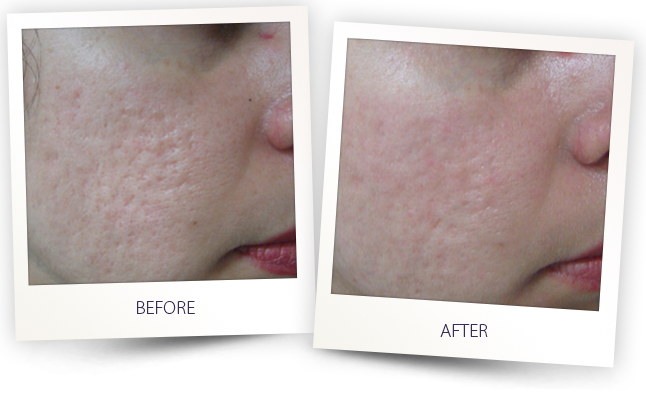 How to Get Rid of Acne Scars on Face in Urdu