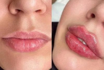 How Much Do Lip Fillers Cost in Urdu