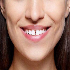 How Much Do Braces Cost in Pakistan in Urdu