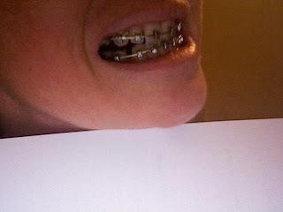 How Long Do Braces Take to Close Extraction Gaps in Urdu
