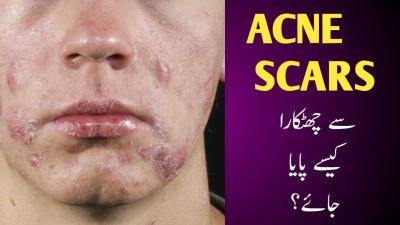 How to Get Rid of Pimples on Forehead Overnight in Urdu