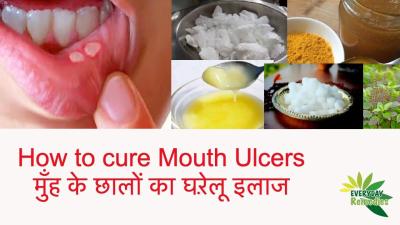How to Treat Mouth Ulcers at Home in Urdu