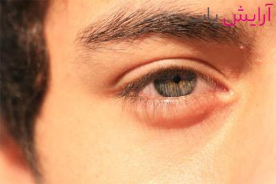 How to Reduce Puffy Eyes in Urdu