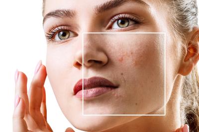 How to Remove Brown Spots on Face in Urdu