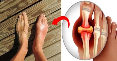 How to Reduce Uric Acid in Urdu