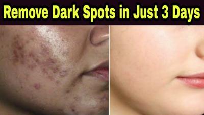 How to Get Rid of Dark Spots on Feet in Urdu