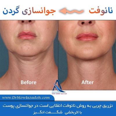 How to Remove Neck Lines in Urdu