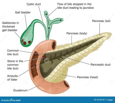 How to Stop a Gallbladder Attack While It Is Happening in Urdu