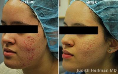How to Get Rid of Acne Scars on Face in Urdu